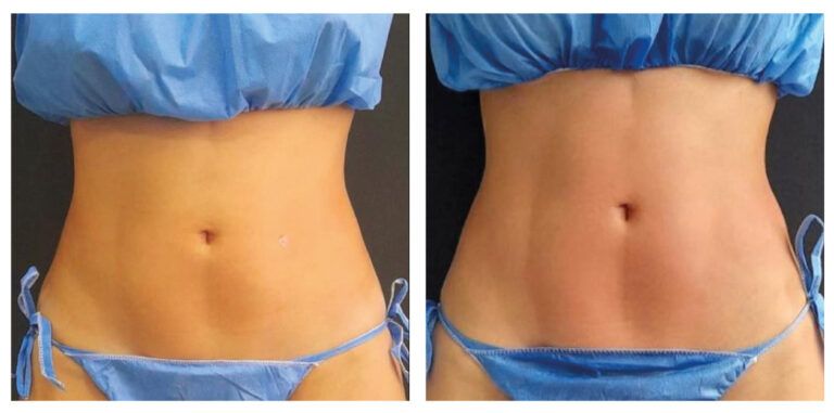 Rejuvenecimiento Facial