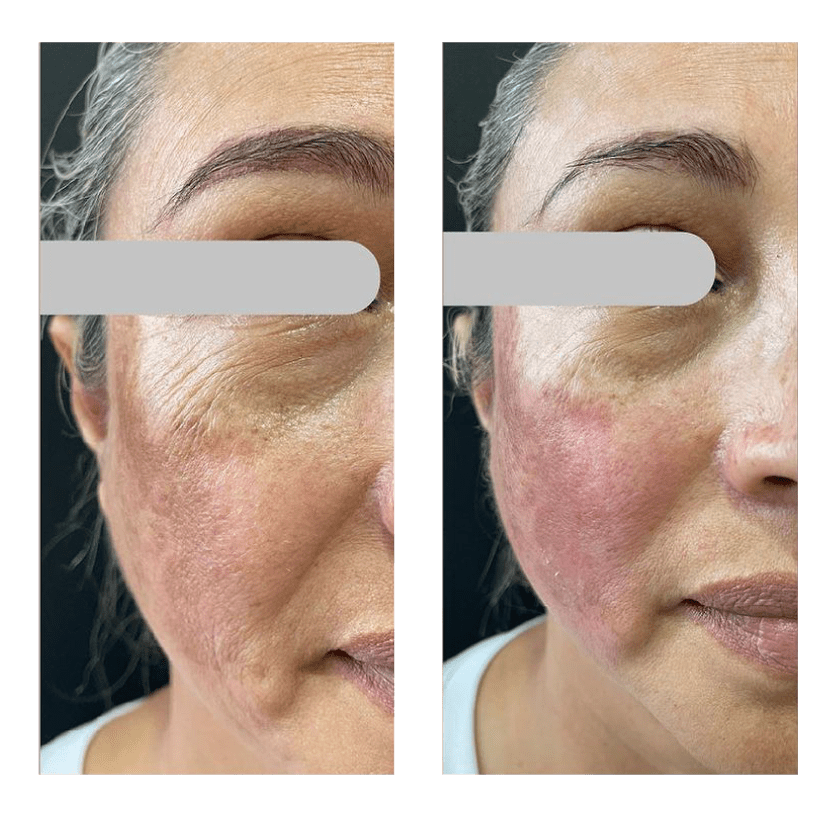 Rejuvenecimiento Facial