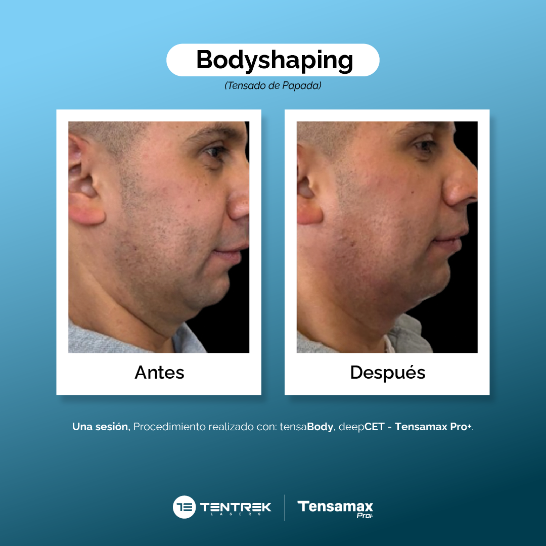Bodyshaping - Tensado de Papada