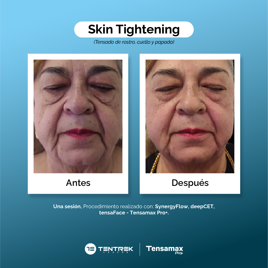 Skin Tightening - Tensado Facial