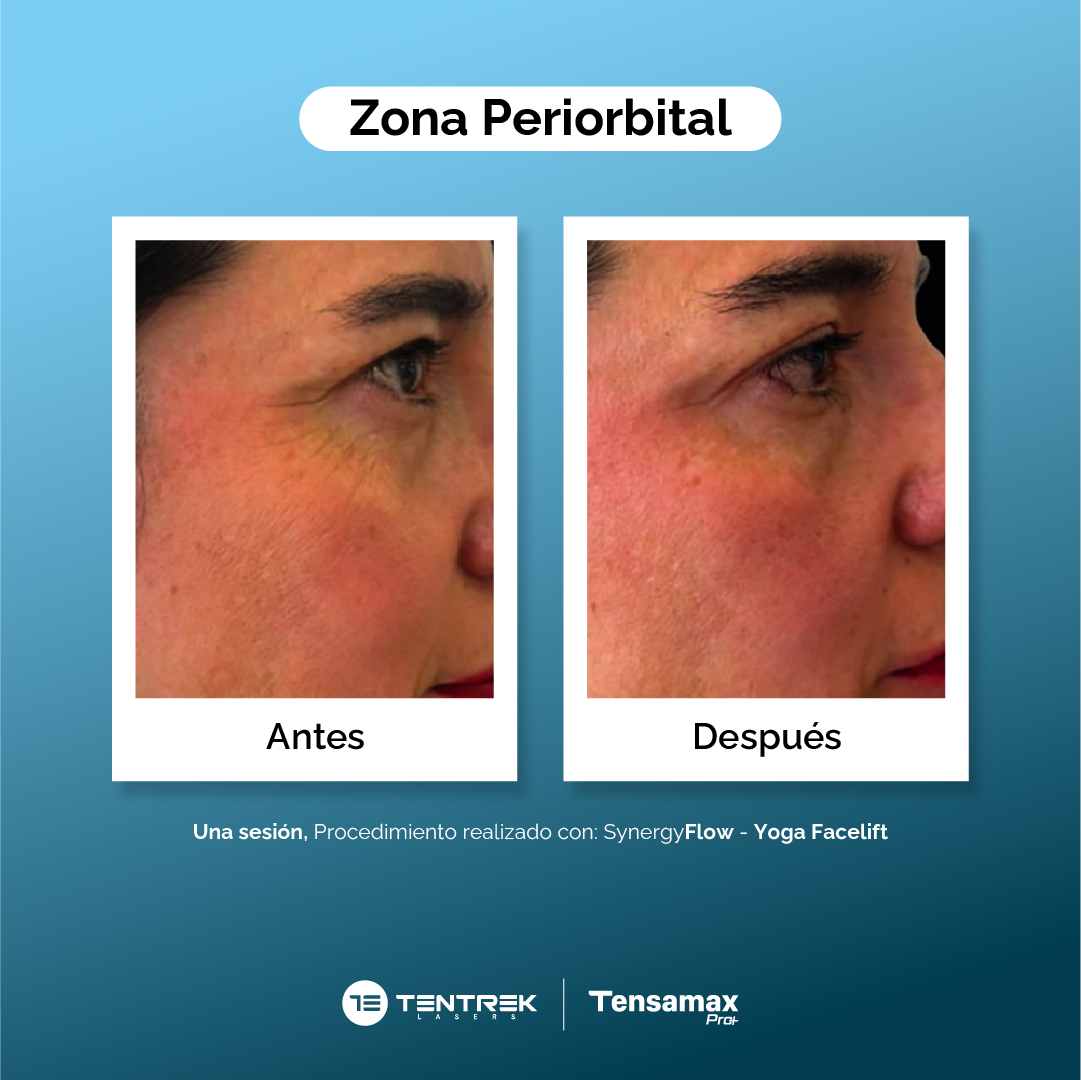 Zona Periorbital