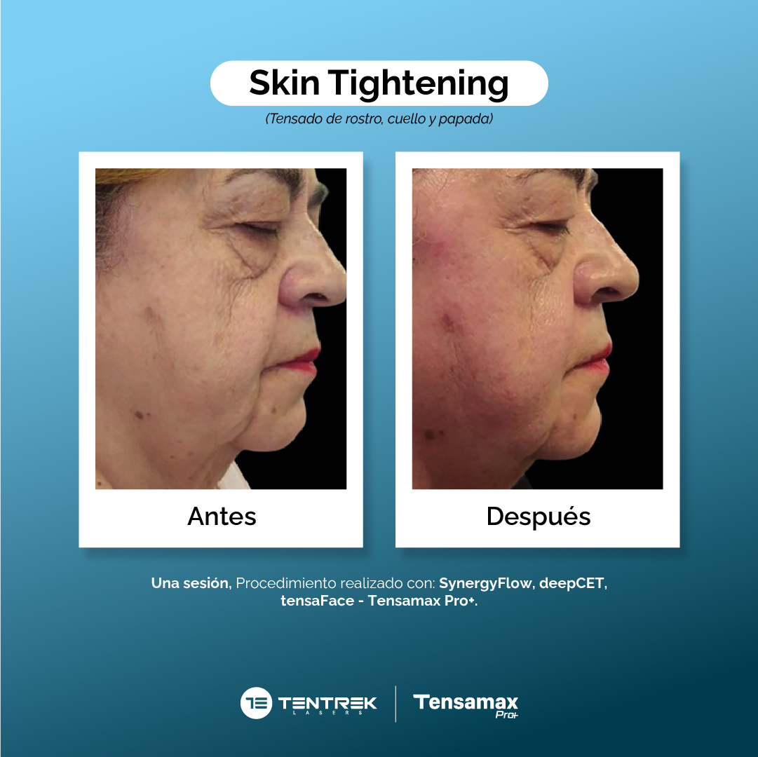 Skin Tightening - Rostro y Cuello
