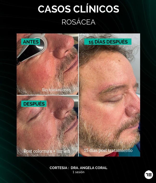 Tratamiento Acné Recover LED